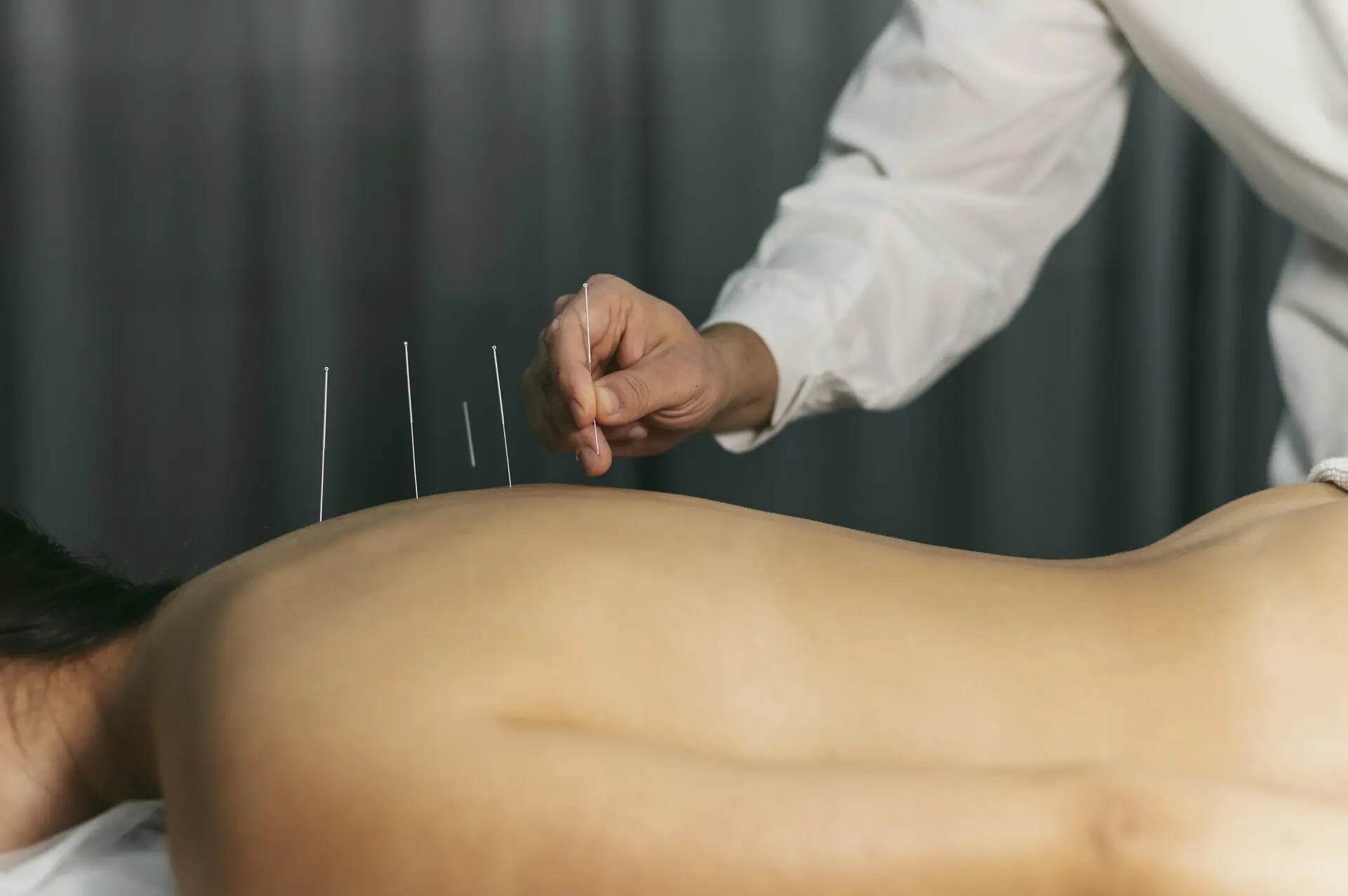 Qualified physiotherapist performing dry needling acupuncture treatment on trigger points to release muscle tension and relieve pain
